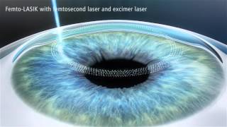 Zeiss  LASIK with femtosecond laser and excimer laser [upl. by Karame]