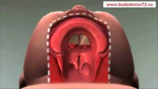 CLEFT LIP AND PALATE ANIMATION [upl. by Feirahs739]