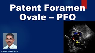 Patent Foramen Ovale – PFO [upl. by Eudoca]