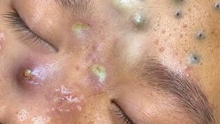 Big Cystic Acne Blackheads Extraction Blackheads amp Milia Whiteheads Removal Pimple Popping  8356 [upl. by Ennairac942]