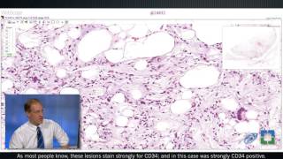 Pathology Insights WellDifferentiated Lipomatous Tumors with John Goldblum MD [upl. by Nelehyram626]