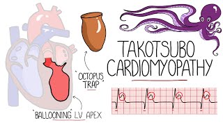 Takotsubo Cardiomyopathy Explained Broken Heart Syndrome [upl. by Felice]