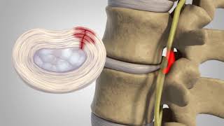 Herniated Disc  Patient Education [upl. by Kingsley]