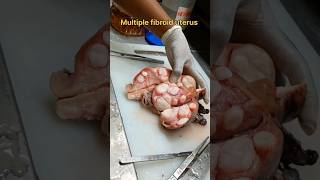 Multiple fibroid uterus specimen [upl. by Hatnamas]