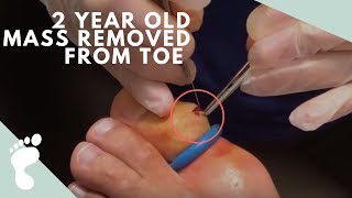 2 Year Old Mass Removed From Toe [upl. by Akalam]