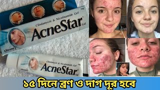 Acnestar gel review Acnestar gel Acne start gel for acne amp pimple skin AcneStar Moriom Akter Mim [upl. by Ahsiekin644]