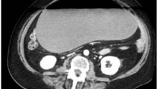 Gastric Volvulus [upl. by Loreen]