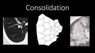 Chest Radiology  Patterns  Airspace [upl. by Ennaed]