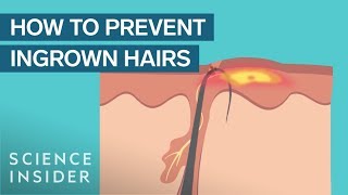 What Are Ingrown Hairs — And How To Treat Them [upl. by Ajiam]