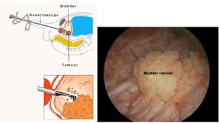 Urinary bladder Tumour  First investigation amp First Treatment [upl. by Sarad302]