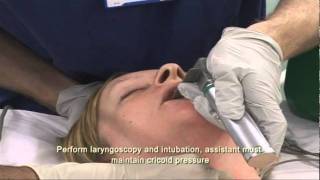 Intubation Extubation 37 [upl. by Ydnih]