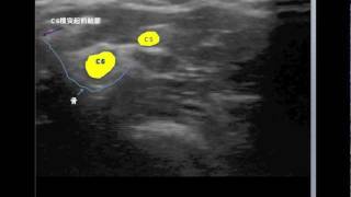 C5C6 cervical nerve root blocks [upl. by Aneek]