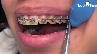 Lace ties and Power chains  Braces Tooth Time Family Dentistry New Braunfels [upl. by Humpage]