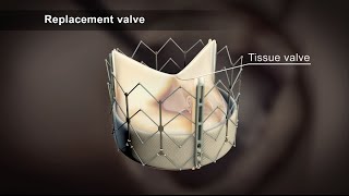 TAVI Transcatheter Aortic Valve Implantation [upl. by Suirtemed]