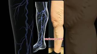 Varicose veins and treatment [upl. by Myriam]