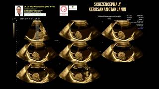 Schizencephaly [upl. by Ttreve]