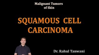 Squamous Cell Carcinoma [upl. by Haneen]