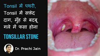 TONSILLAR STONETonsil मै पथरी मुँह से बदबू गले में दर्द  tonsil में सफ़ेद दाग  गले मैं फसा होना [upl. by Gamal]