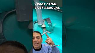 Removing a Root Canal Post  In Office to Hands On Dental Training shorts [upl. by Holtz156]