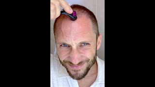 How I Use DermaRoller for Hair Growth and To Solve my Baldness and Hair Loss Tutorial 4k [upl. by Livy667]