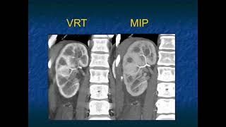 The Differential Diagnosis of Loss of Renal Corticomedullary Interface  Part 1 [upl. by Eda970]