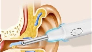 Ear cleaning camera incredible image [upl. by Lehcer]