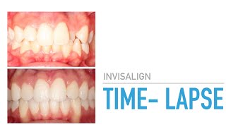 Invisalign TimeLapse TheOrthodonticCentre [upl. by Ilat]