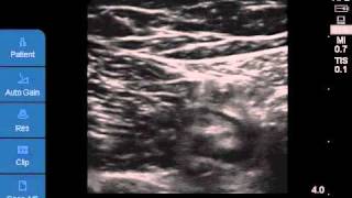 Ultrasoundguided Saphenous Nerve Block [upl. by Nirol]