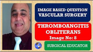 THROMBOANGITIS OBLITERANS  VASCULAR SURGERY  Image Based Question [upl. by Faulkner656]