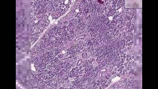 Histopathology Pancreas   Adenocarcinoma [upl. by Ydaf]