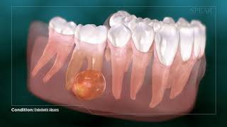 Dental Abcess  Why Root Canal Treatment Is Needed [upl. by Enrobyalc]