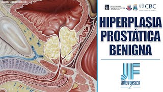 Aula HIPERPLASIA PROSTÁTICA BENIGNA HPB  Urologia  João Fonseca [upl. by Channing]