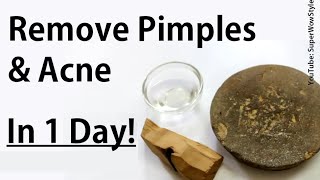 Get Rid of Pimples amp Acne in 1 Day How To Remove Pimples Overnight Acne Treatment SuperWowStyle [upl. by Varick819]