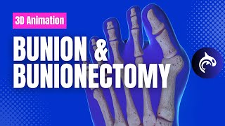 Bunion and Bunionectomy with Osteotomy  3D Animation [upl. by Ash154]