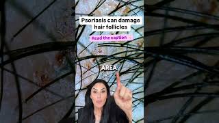 The Hidden Danger of Psoriasis to Your Hair Follicles [upl. by Frisse]