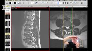 Clinical Series How to See a Pinched Nerve Foraminal Stenosis on MRI [upl. by Frodine]