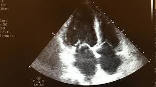 Anterior mitral valve leaflet chordae rupture with severe mitral regurgitation [upl. by Breech595]