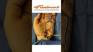 Treatment of Guyon’s canal syndrome Ulnar tunnel syndrome shorts [upl. by Alil]