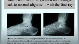 HyProCure® Before amp After TaloTarsal Stabilization [upl. by Nhguahs350]