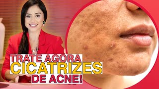 CICATRIZES DE ACNE TRATE SUAS CICATRIZES DE ACNE COM ESSAS 3 DICAS ALTAMENTE EFICIENTES [upl. by Yreved]