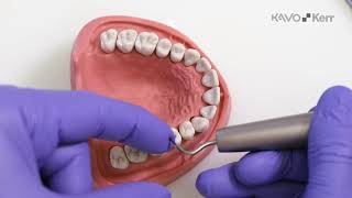 SONICflex stripping amp shaping tips – clinical case 01 [upl. by Dnalon]