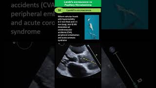 Lambls Excrescences vs Papillary Fibroelastoma [upl. by Assiralc]