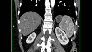 Abdomen Liver Hemangioma of the Liver2 of 8 [upl. by Ayikaz]