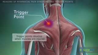 Myofascial pain syndrome and trigger points Reasons [upl. by Bromleigh818]