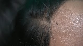 Lice and Nits Damage my Hair  Lice Popping Sounds [upl. by Beller]