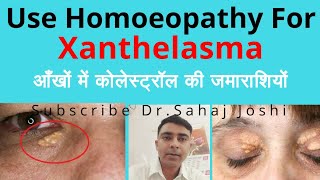 Xanthelasma Homeopathic medicine for Xanthelasma [upl. by Zacherie]