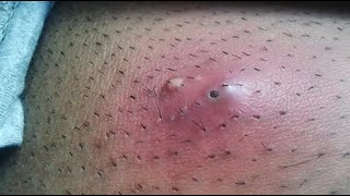 Big Cystic Acne Blackheads Extraction Blackheads amp Milia Whiteheads Removal Pimple Popping [upl. by Llerehs]