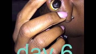 Keloid Removal Rubber Band Process [upl. by Lesig]