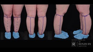 Lipedema Evaluation Diagnosis and Treatment Plan [upl. by Adidnac]