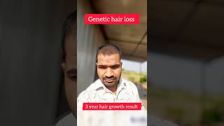 3 Years Minoxidil hair growth results 🔥shorts hairstyle hair [upl. by Gehlbach]